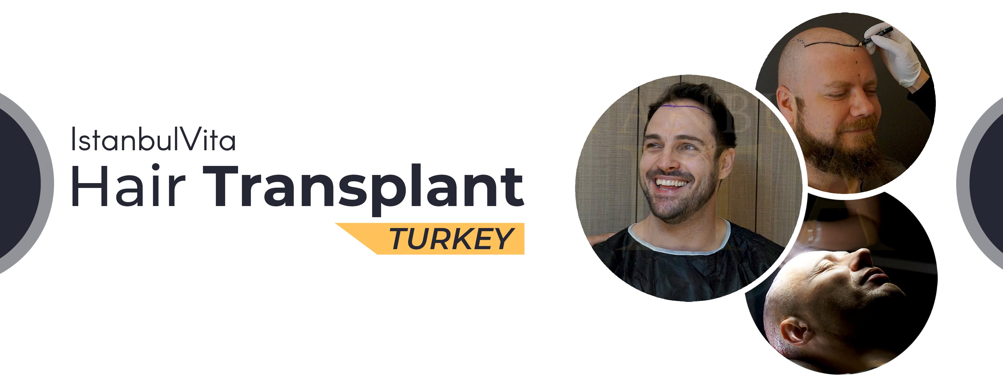 İstanbul Vita Hair Transplant Clinic - Istanbul Turkey cover