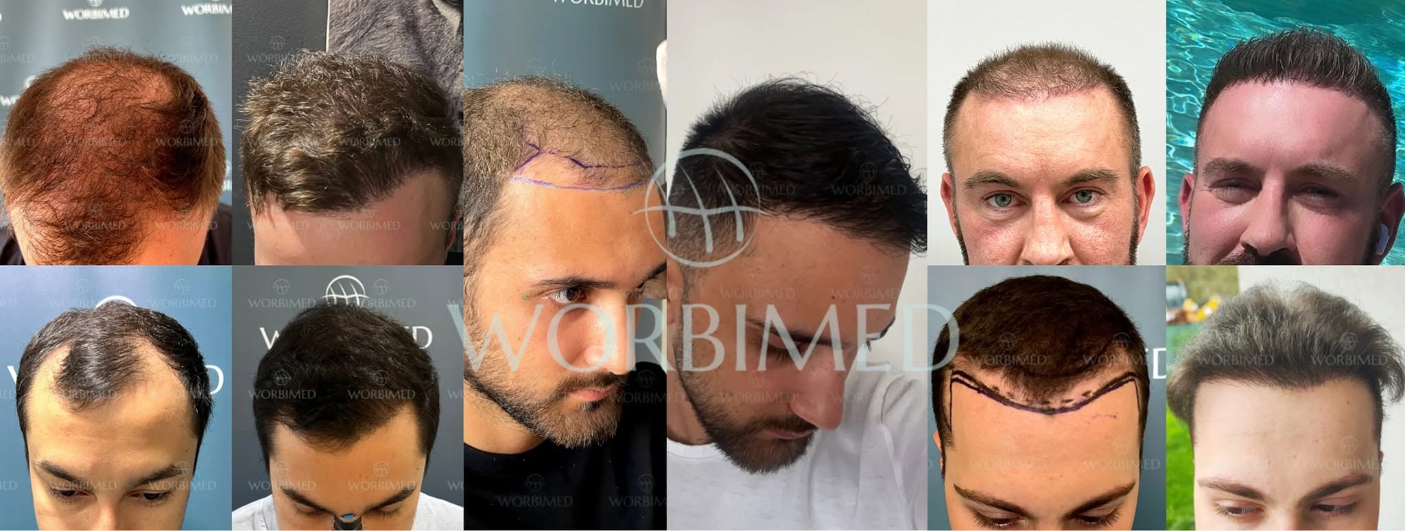 Worbimed | Hair Transplant Turkey Istanbul | Eyebrow Transplant | Beard Transplant cover