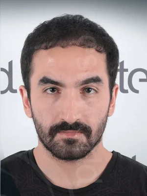Hair Transplant - After