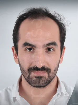 Hair Transplant - Before