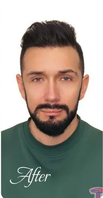 Hair Transplant - After