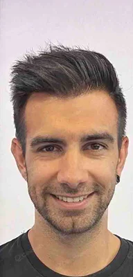 Hair Transplant - After