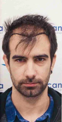 Hair Transplant - Before