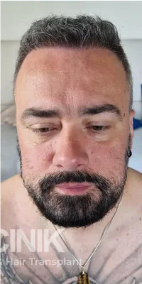 FUE Hair Transplant - After