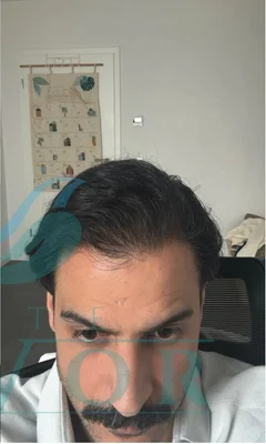 Hair Transplant - After