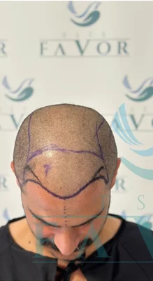 Hair Transplant - Before