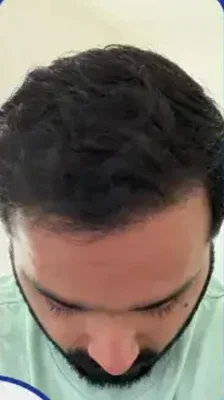 Hair Transplant - After