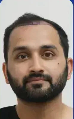 Hair Transplant - Before