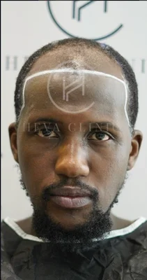 Fue Hair Transplant - Before