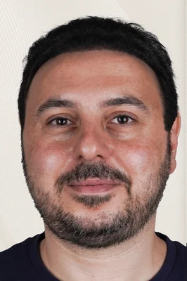 Hair Transplant - After