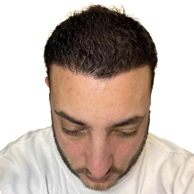 Hair Transplant - After