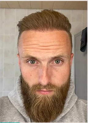 Hair Transplant - After
