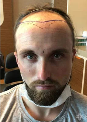 Hair Transplant - Before