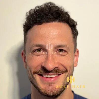Hair Transplant - After