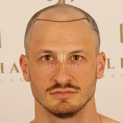 Hair Transplant - Before