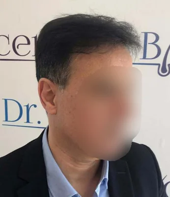 micromotor FUE - After
