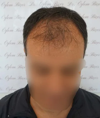 micromotor FUE - Before