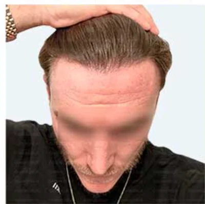 Hair Transplant - After