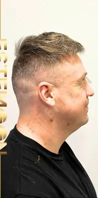 Hair Transplant - After