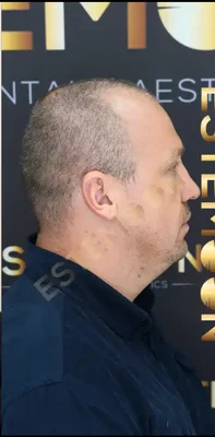 Hair Transplant - Before