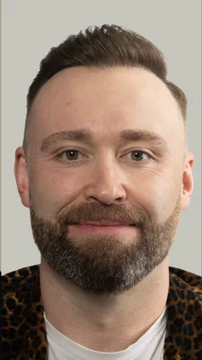 DHI Hair Transplant - After