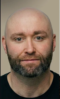 DHI Hair Transplant - Before