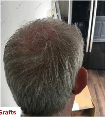 Hair Transplant - After