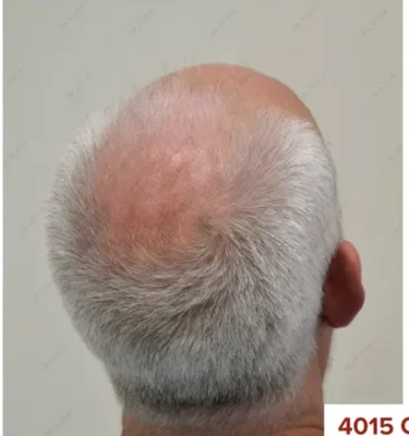 Hair Transplant - Before