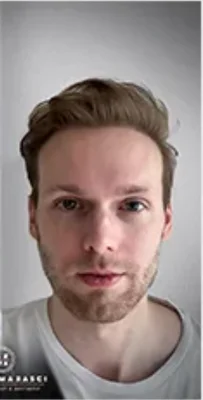 Hair Transplant - After