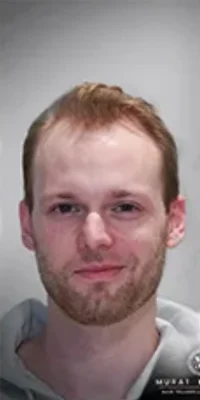 Hair Transplant - Before