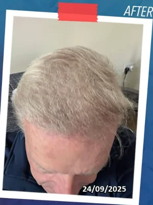 Hair Transplant - After