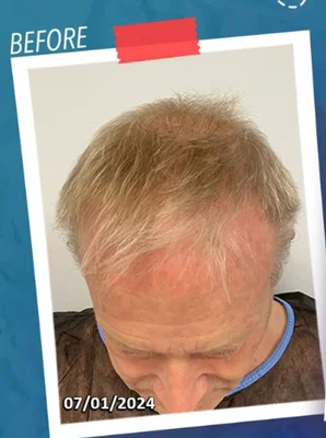 Hair Transplant - Before