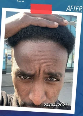 Hair Transplant - After