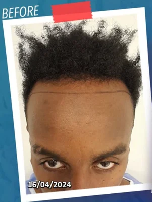 Hair Transplant - Before