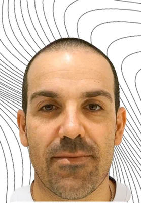 Hair Transplant - Before