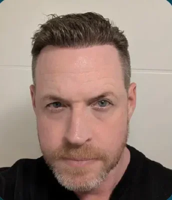FUE Hair Transplant - After