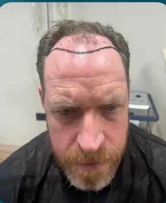 FUE Hair Transplant - Before