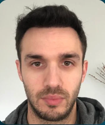 FUE Hair Transplant - After