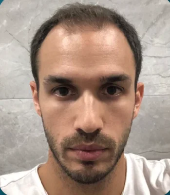 FUE Hair Transplant - Before