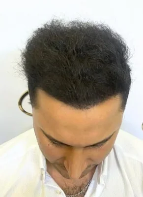 Hair Transplant - After