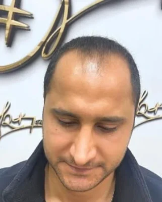 Hair Transplant - Before