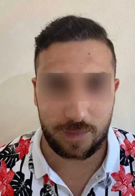 Hair Transplant - After