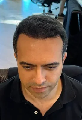 Sapphire FUE Hair Transplant - After