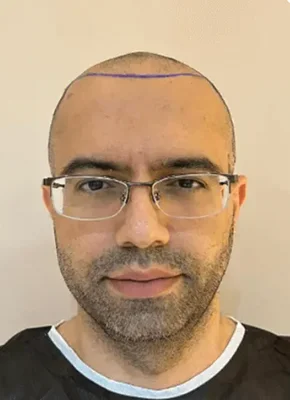 Sapphire FUE Hair Transplant - Before