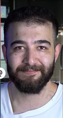 Hair Transplant - After