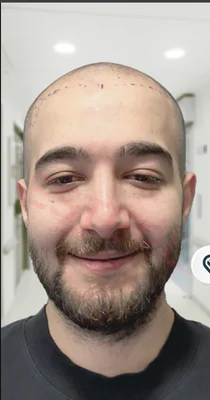 Hair Transplant - Before