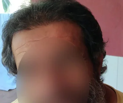Hair Transplant - After