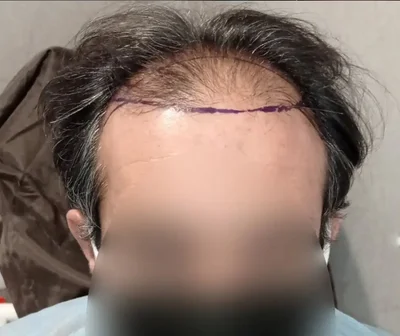 Hair Transplant - Before