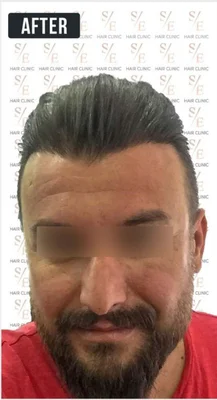 Hair Transplant - After