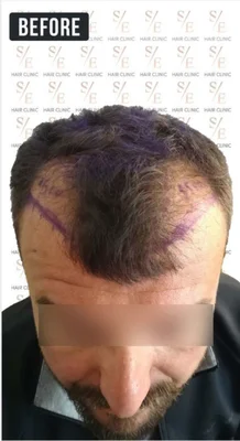 Hair Transplant - Before